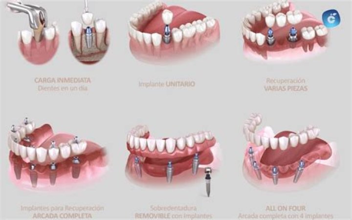 dónde hacerlo, precio, tipos de implantes